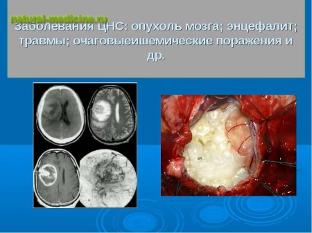 Якщо підскочило артеріальний тиск. Що слід робити якщо підвищився тиск