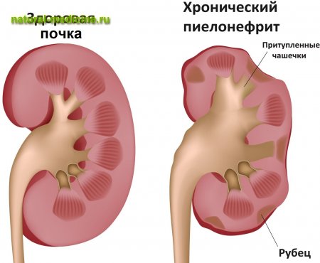 Якщо підскочило артеріальний тиск. Що слід робити якщо підвищився тиск