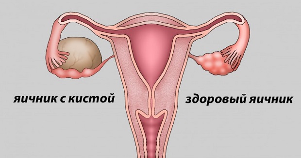 Чому болить лівий бік перед місячними. Лікування і профілактика. Ефективні методики лікування