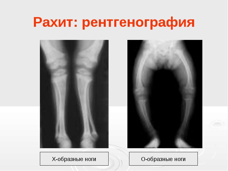 Ознаки рахіту що робити. Рахіт у дітей: симптоми і лікування. Як уникнути рахіту у дитини? Інші симптоми рахіту у д